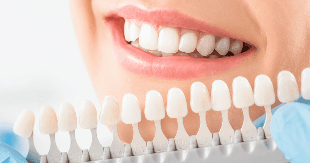 審美歯科での治療