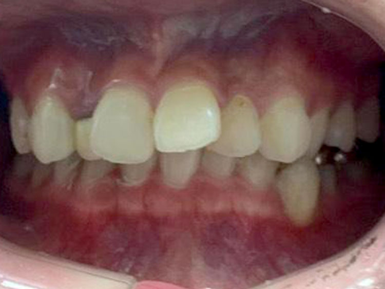 BEFORE